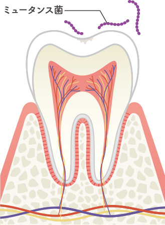 歯の表面が虫歯になりかけている状態