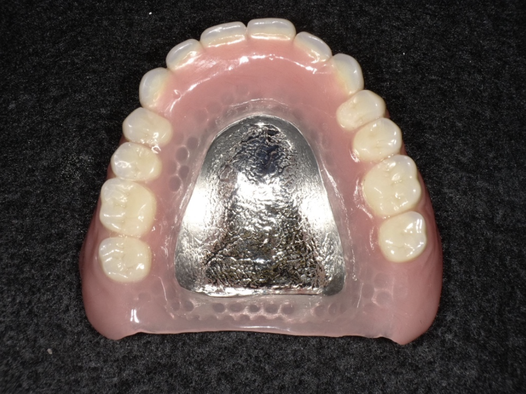 金属床義歯について