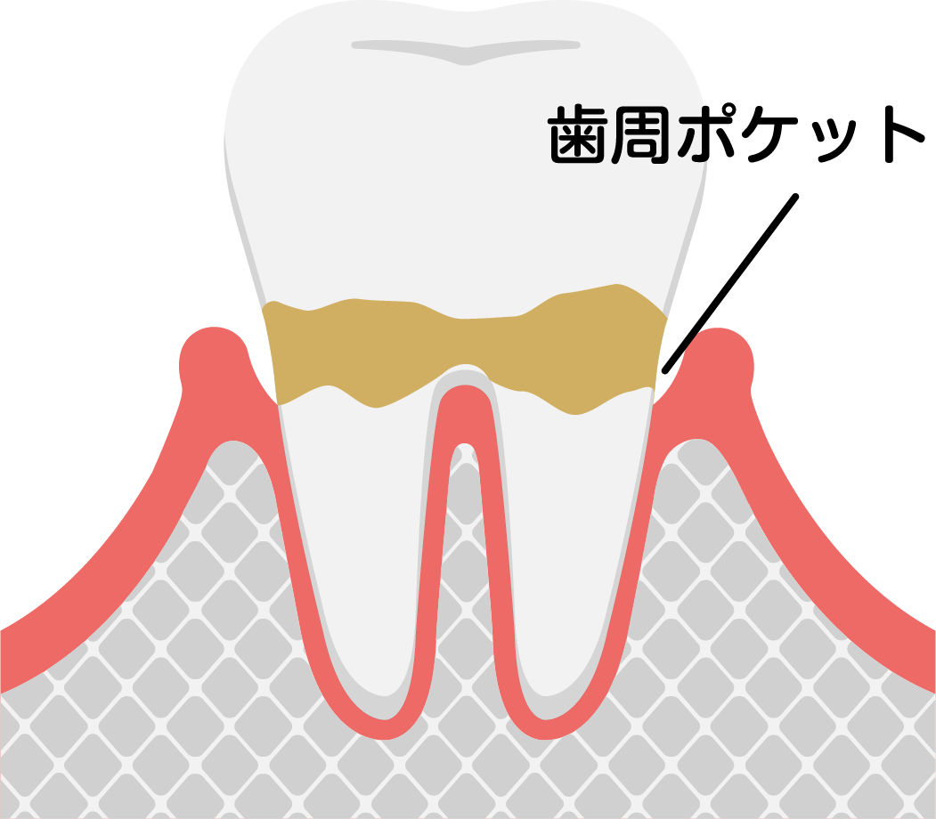 歯周炎（軽度）
