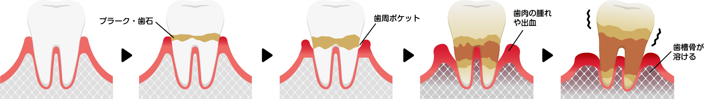 歯周病の進行状況について