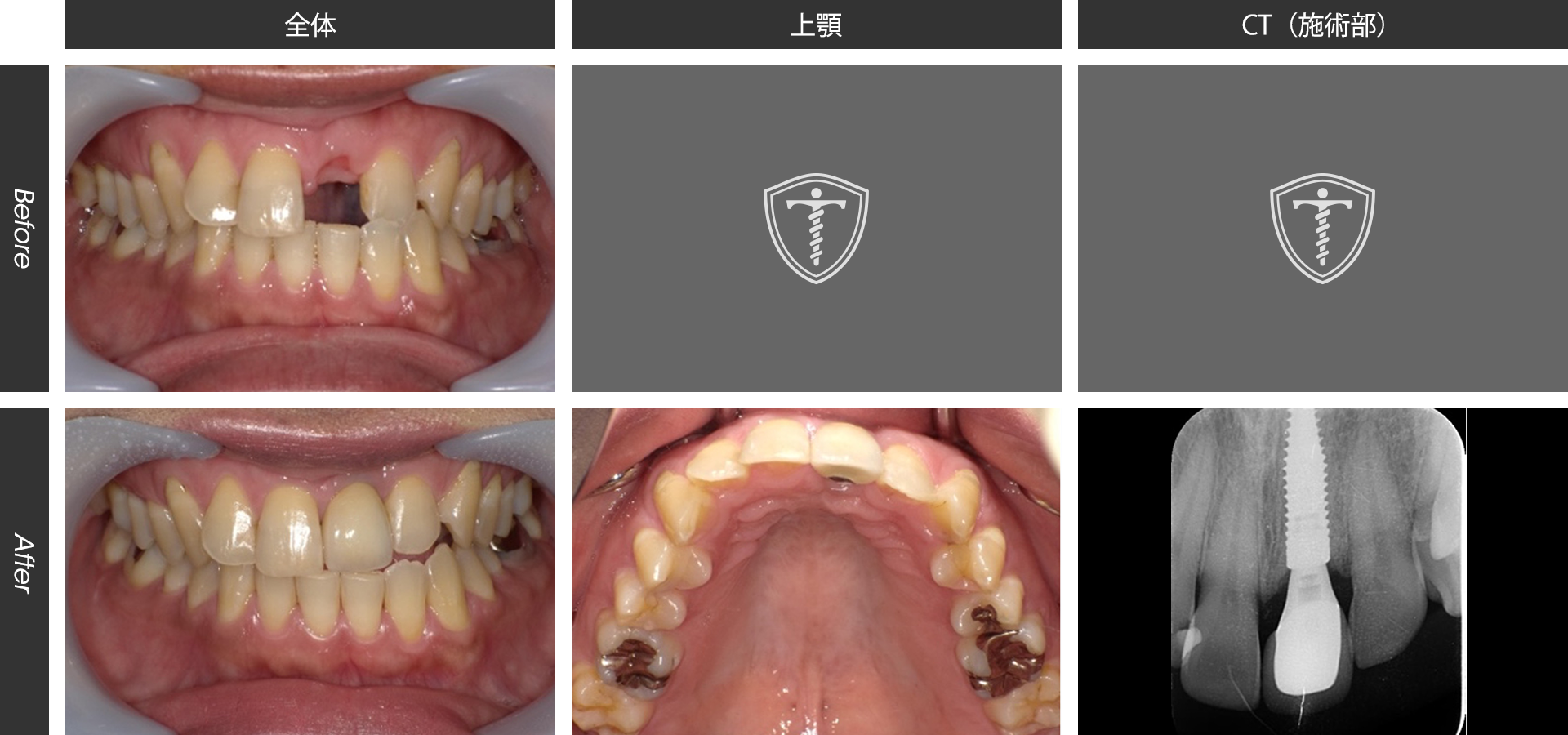 上顎前歯１本のインプラント治療