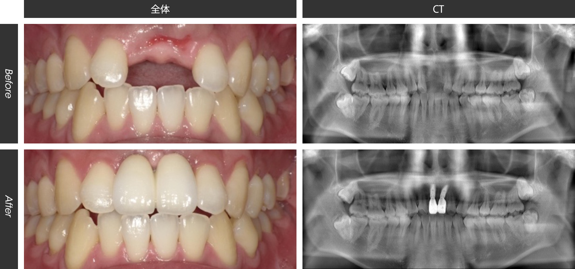 上顎前歯２本のインプラント治療