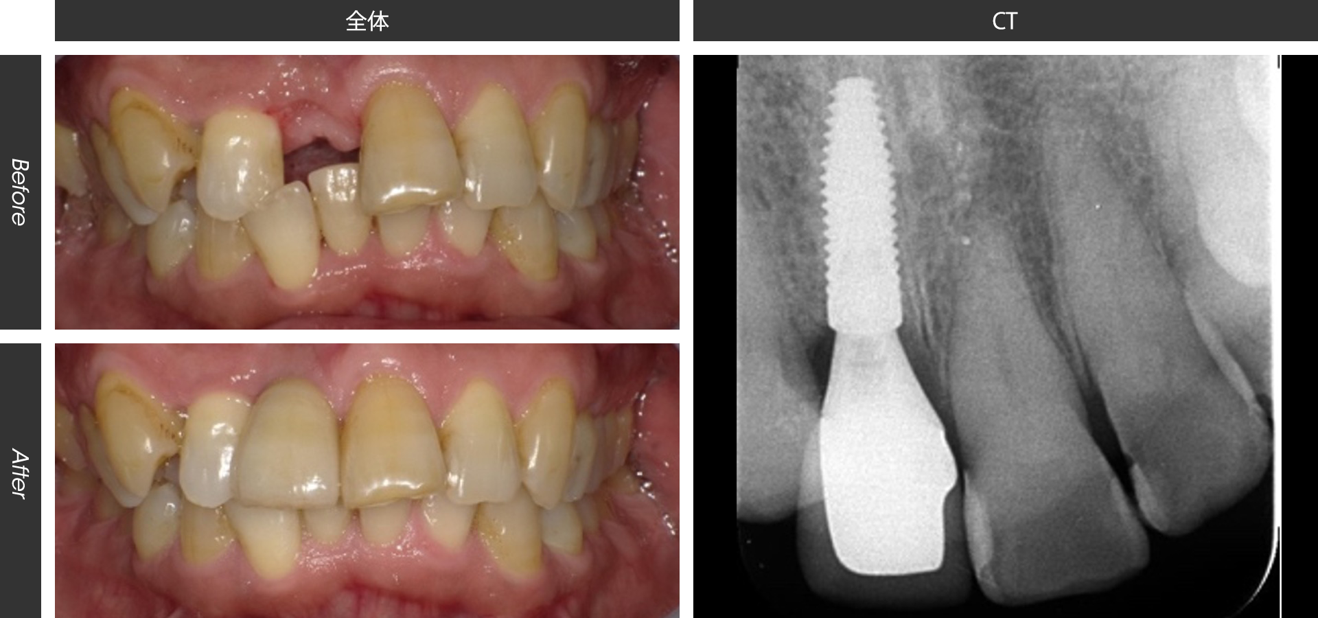歯列不正がある患者様への上顎前歯部インプラント治療