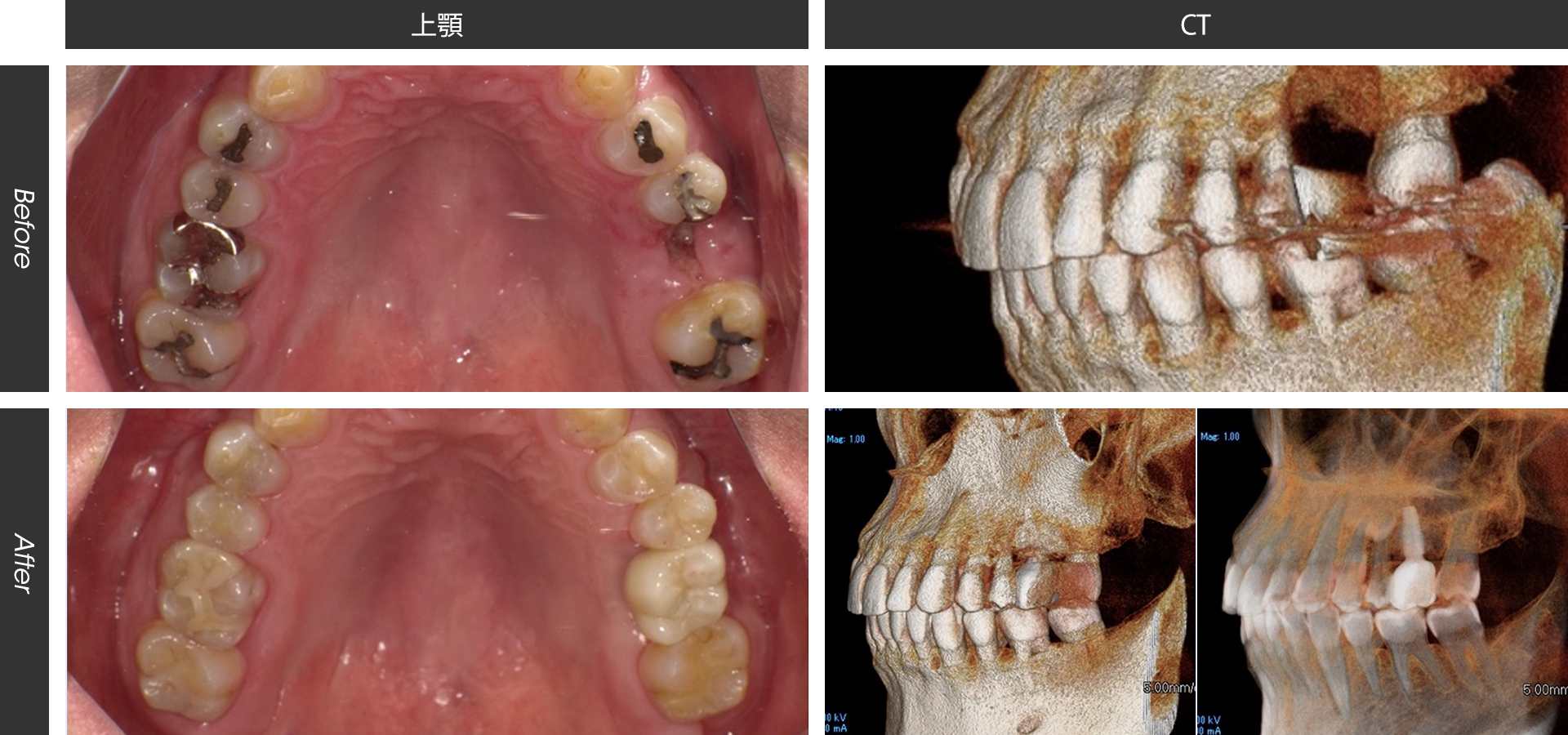左上臼歯の骨移植とインプラント治療