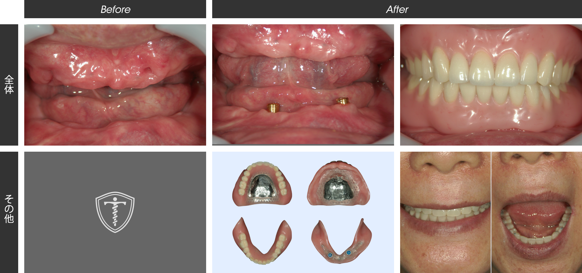 下顎無歯顎に対するインプラントオーバーデンチャー治療